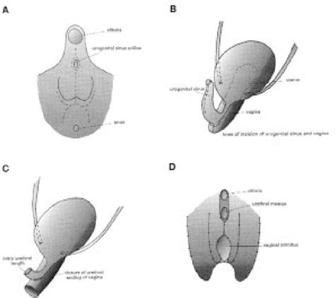 intersex genitals.